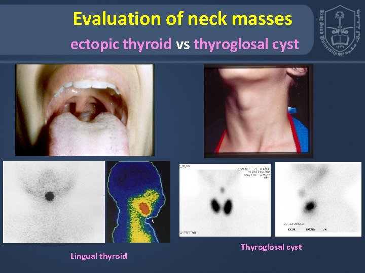 Evaluation of neck masses ectopic thyroid vs thyroglosal cyst Lingual thyroid Thyroglosal cyst 