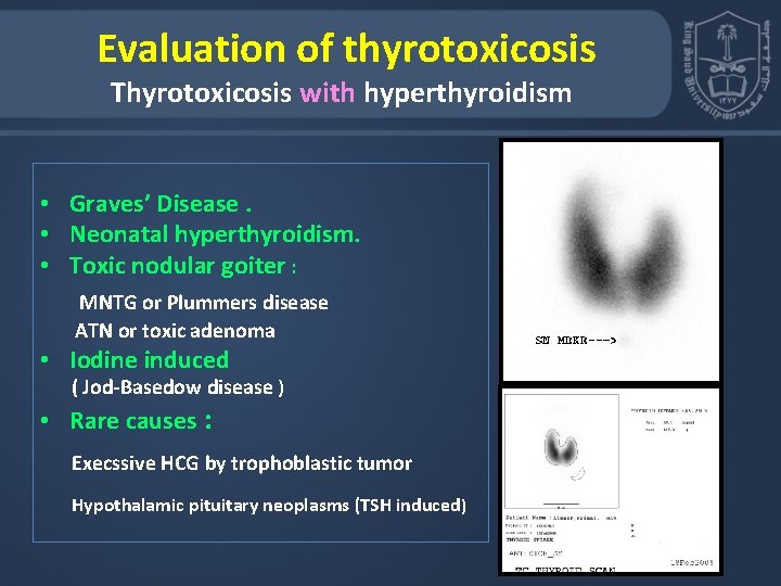  Evaluation of thyrotoxicosis Thyrotoxicosis with hyperthyroidism • Graves’ Disease. • Neonatal hyperthyroidism. •