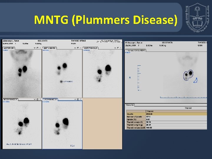 MNTG (Plummers Disease) 