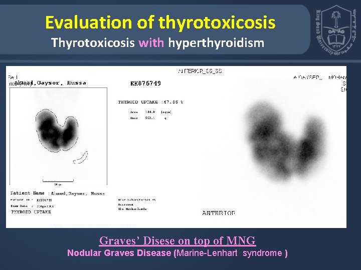  Evaluation of thyrotoxicosis Thyrotoxicosis with hyperthyroidism Graves’ Disese on top of MNG Nodular