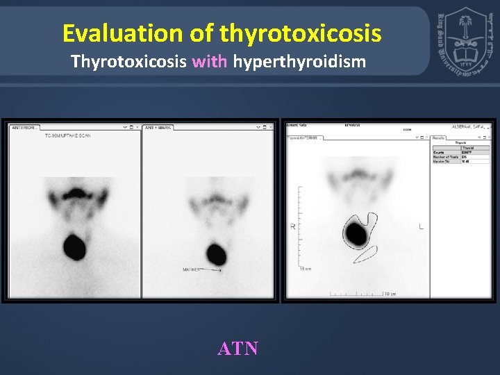  Evaluation of thyrotoxicosis Thyrotoxicosis with hyperthyroidism ATN 