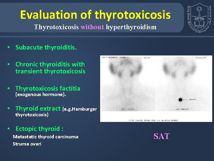 Evaluation of thyrotoxicosis Thyrotoxicosis without hyperthyroidism • Subacute thyroiditis. • Chronic thyroiditis with transient