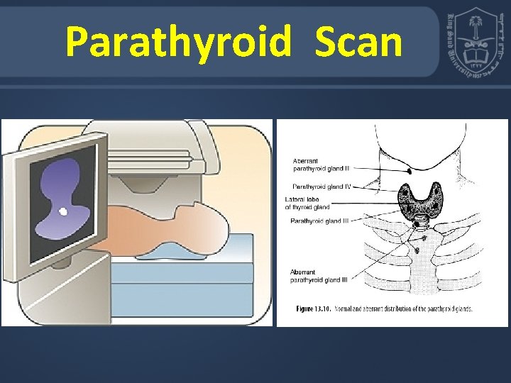 Parathyroid Scan 