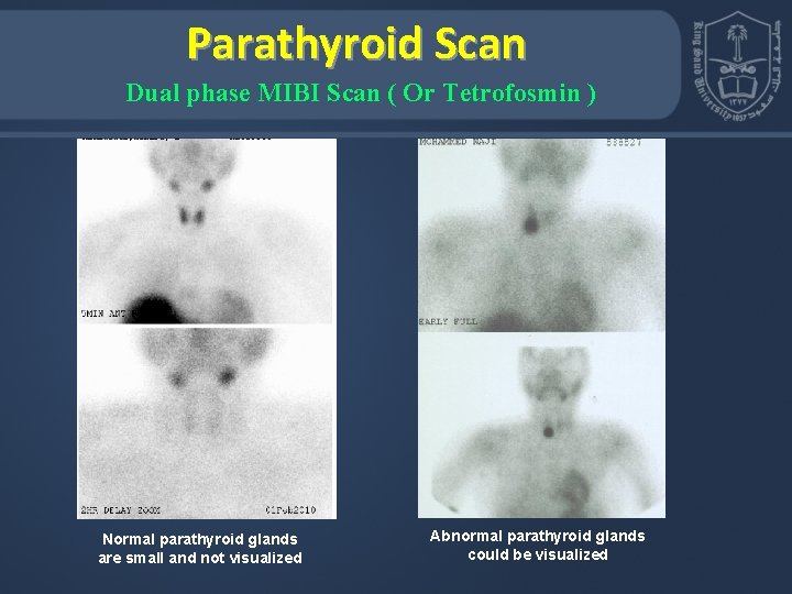 Parathyroid Scan Dual phase MIBI Scan ( Or Tetrofosmin ) Normal parathyroid glands are