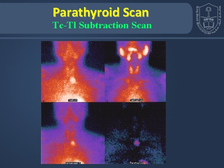 Parathyroid Scan Tc-Tl Subtraction Scan 