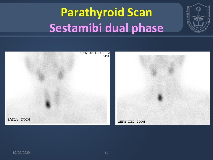 Parathyroid Scan Sestamibi dual phase 10/29/2020 39 