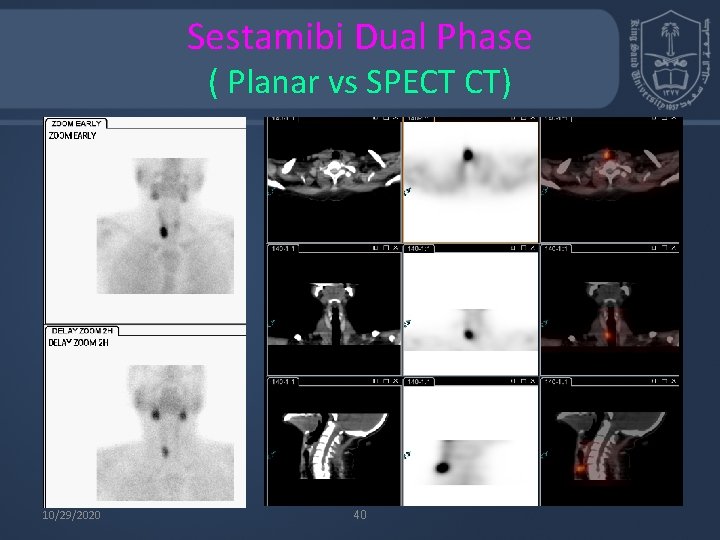 Sestamibi Dual Phase ( Planar vs SPECT CT) 10/29/2020 40 