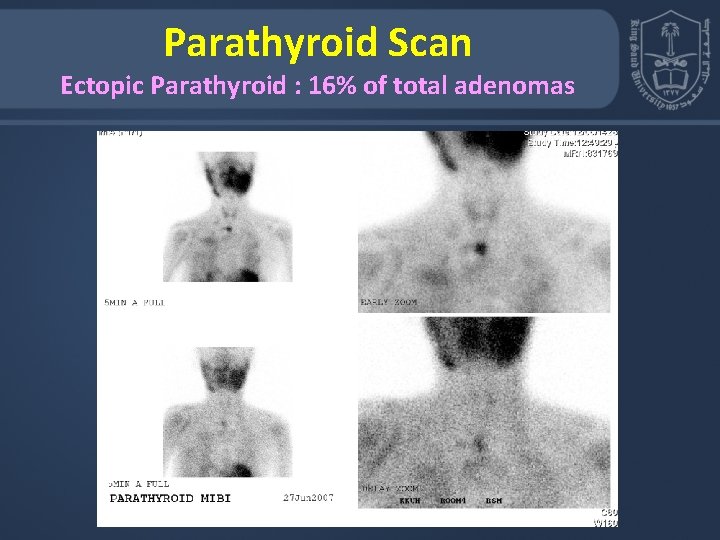 Parathyroid Scan Ectopic Parathyroid : 16% of total adenomas 