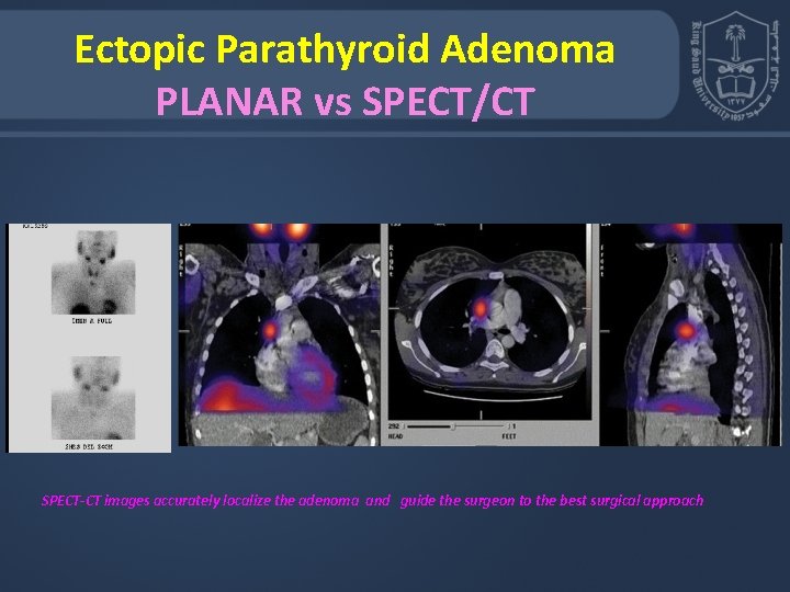 Ectopic Parathyroid Adenoma PLANAR vs SPECT/CT SPECT-CT images accurately localize the adenoma and guide