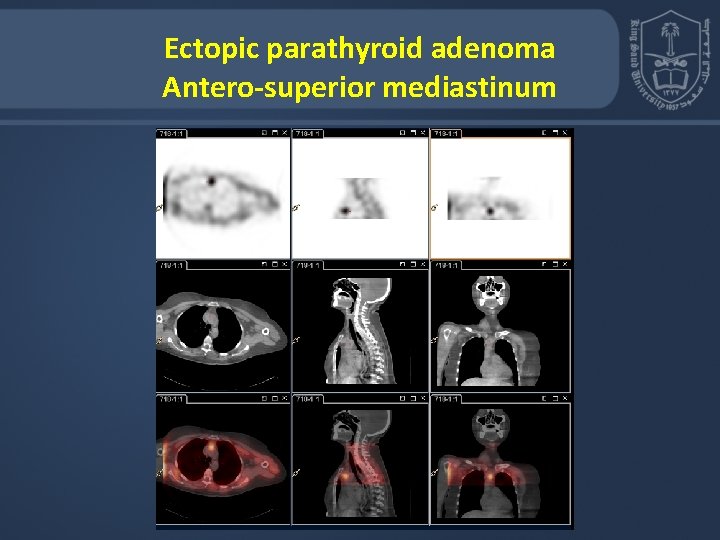 Ectopic parathyroid adenoma Antero-superior mediastinum 