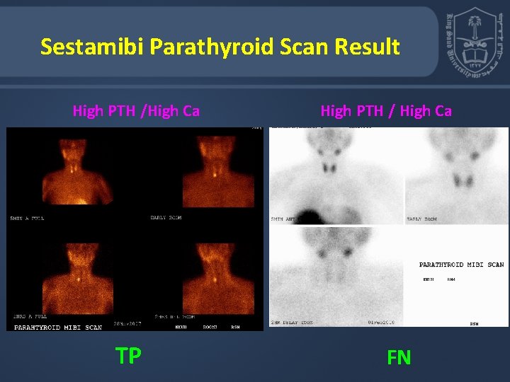 Sestamibi Parathyroid Scan Result High PTH /High Ca TP High PTH / High Ca