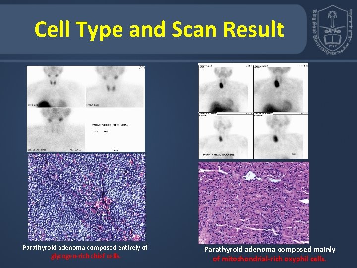 Cell Type and Scan Result Parathyroid adenoma composed entirely of glycogen-rich chief cells. Parathyroid