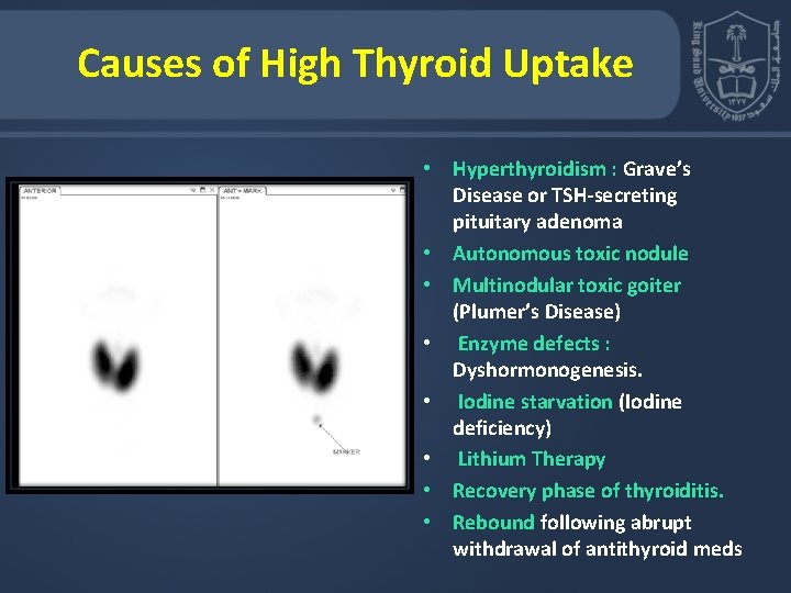 Causes of High Thyroid Uptake • Hyperthyroidism : Grave’s Disease or TSH-secreting pituitary adenoma