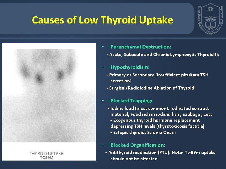 Causes of Low Thyroid Uptake • Parenchymal Destruction: - Acute, Subacute and Chronic Lymphocytic