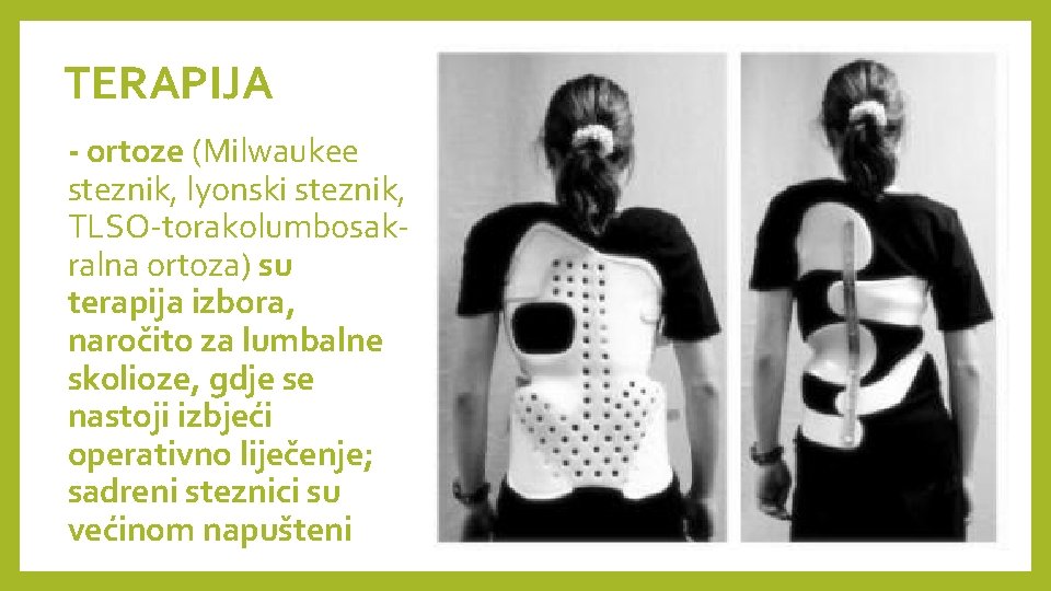 TERAPIJA - ortoze (Milwaukee steznik, lyonski steznik, TLSO-torakolumbosakralna ortoza) su terapija izbora, naročito za