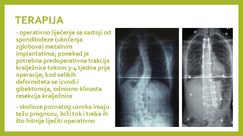 TERAPIJA - operativno liječenje se sastoji od spondilodeze (ukočenja zglobova) metalnim implantatima; ponekad je