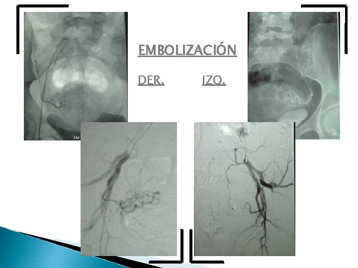 EMBOLIZACIÓN DER. IZQ. 