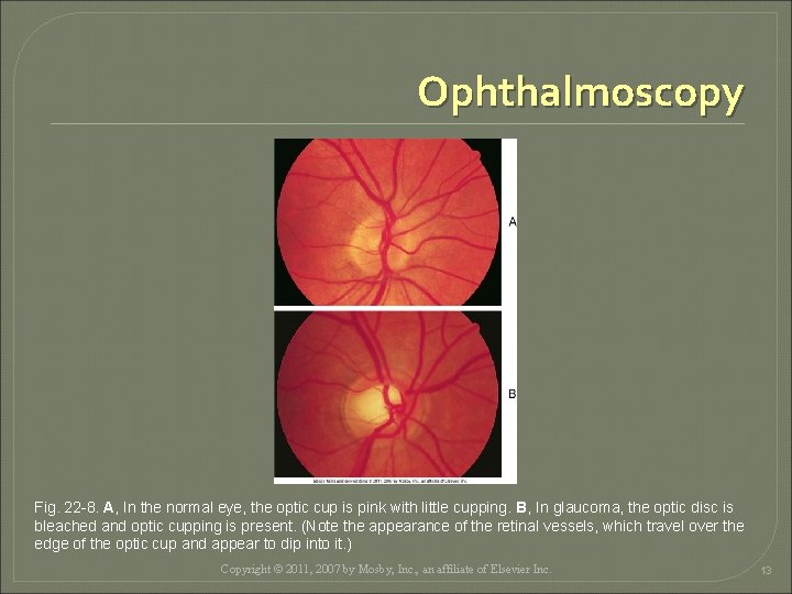 Ophthalmoscopy Fig. 22 -8. A, In the normal eye, the optic cup is pink