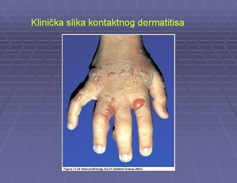 Klinička slika kontaktnog dermatitisa 