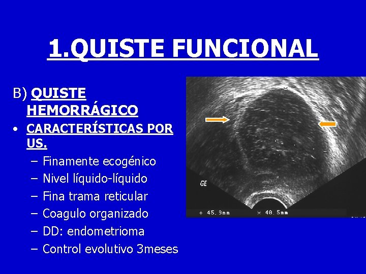 1. QUISTE FUNCIONAL B) QUISTE HEMORRÁGICO • CARACTERÍSTICAS POR US. – Finamente ecogénico –