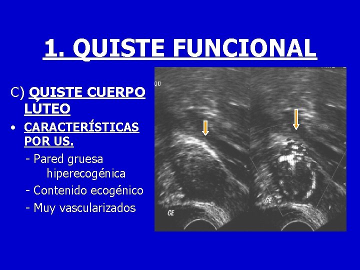 1. QUISTE FUNCIONAL C) QUISTE CUERPO LÚTEO • CARACTERÍSTICAS POR US. - Pared gruesa