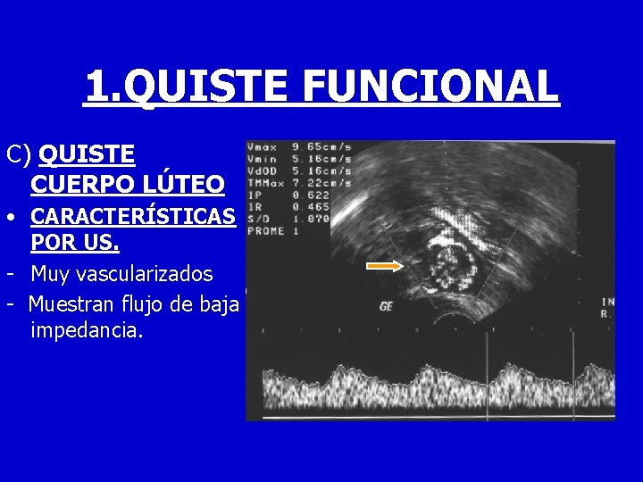 1. QUISTE FUNCIONAL C) QUISTE CUERPO LÚTEO • CARACTERÍSTICAS POR US. - Muy vascularizados