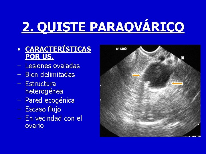 2. QUISTE PARAOVÁRICO • CARACTERÍSTICAS POR US. − Lesiones ovaladas − Bien delimitadas −