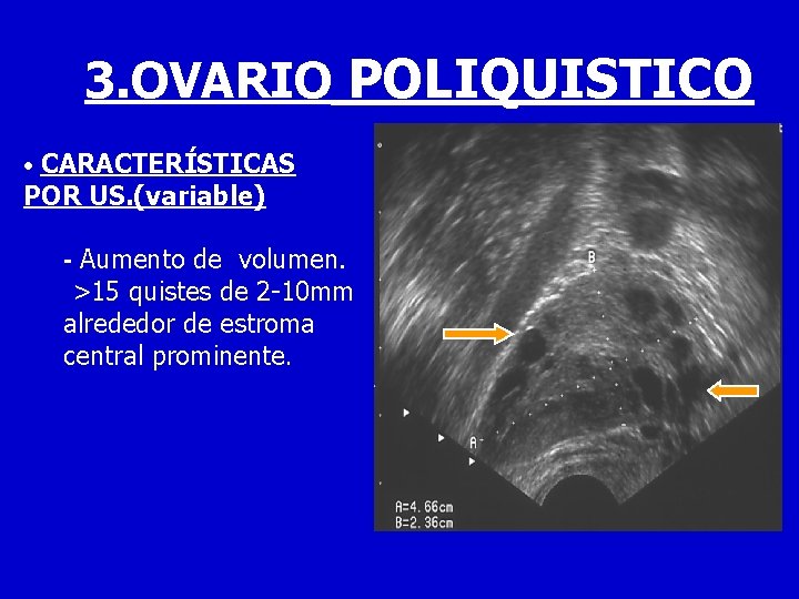 3. OVARIO POLIQUISTICO • CARACTERÍSTICAS POR US. (variable) - Aumento de volumen. >15 quistes