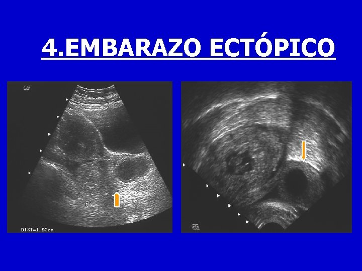 4. EMBARAZO ECTÓPICO 