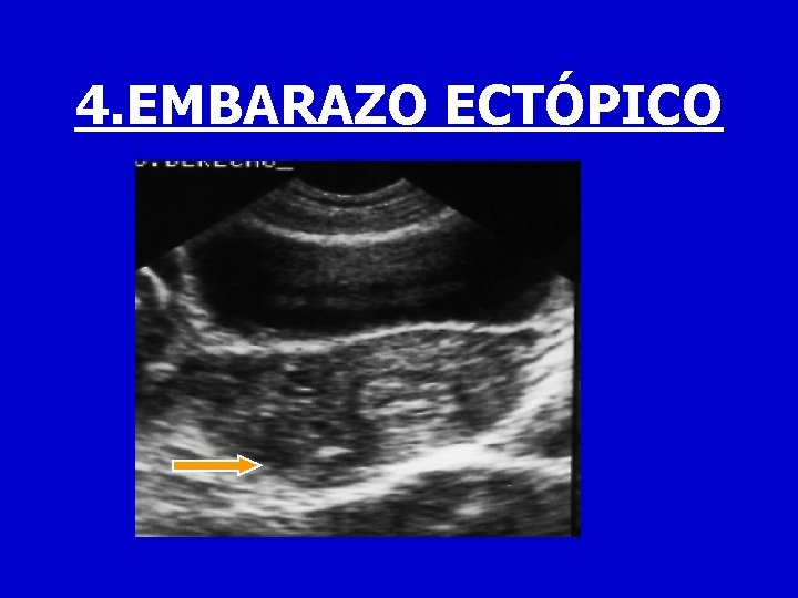 4. EMBARAZO ECTÓPICO 