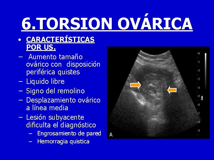 6. TORSION OVÁRICA • CARACTERÍSTICAS POR US. − Aumento tamaño ovárico con disposición periférica