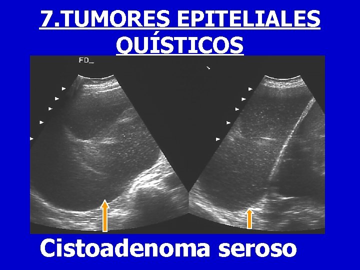 7. TUMORES EPITELIALES QUÍSTICOS Cistoadenoma seroso 