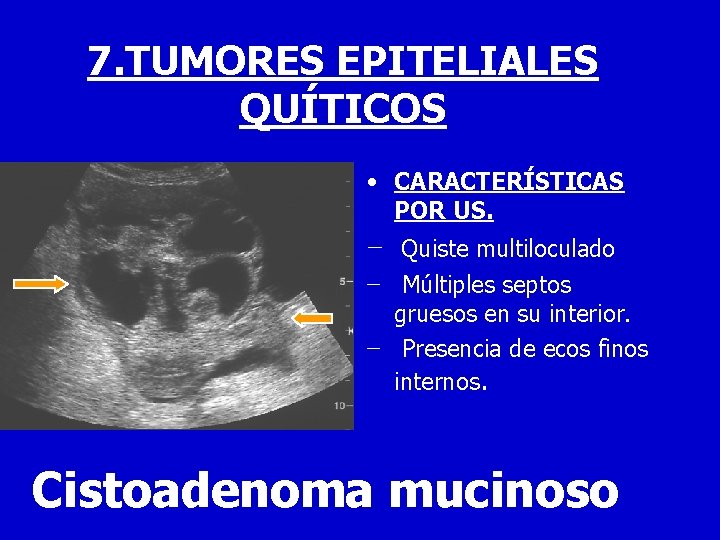 7. TUMORES EPITELIALES QUÍTICOS • CARACTERÍSTICAS POR US. − Quiste multiloculado − Múltiples septos