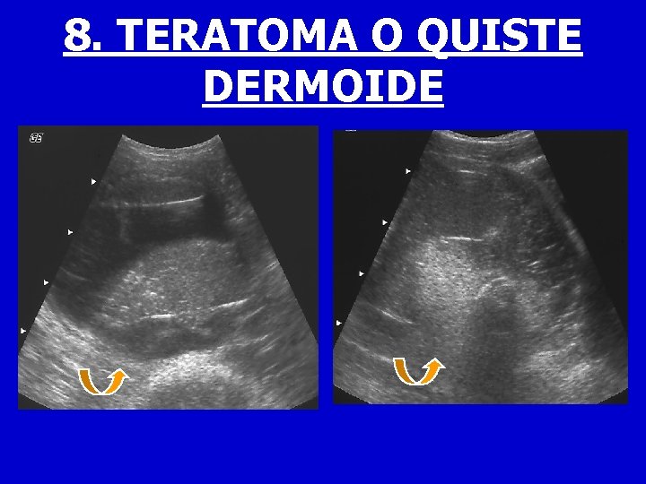 8. TERATOMA O QUISTE DERMOIDE 