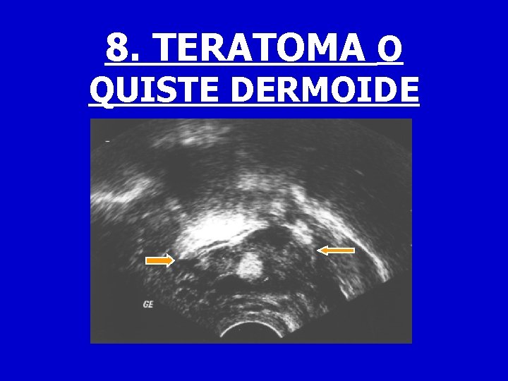 8. TERATOMA O QUISTE DERMOIDE 