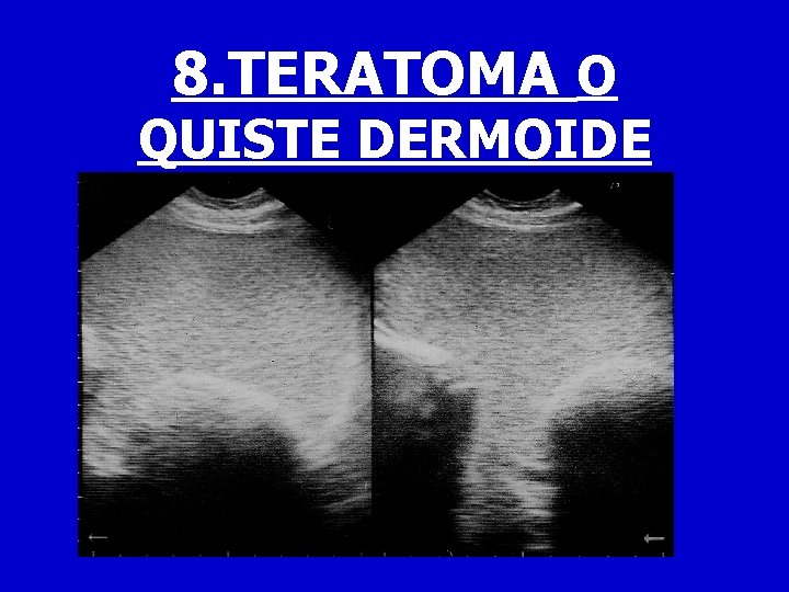 8. TERATOMA O QUISTE DERMOIDE 