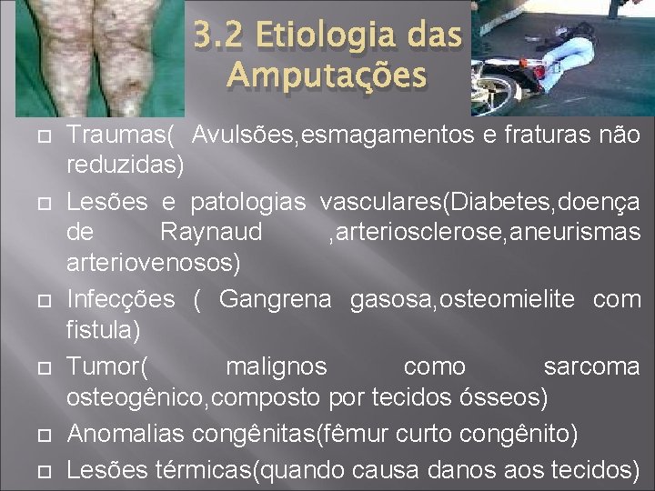 3. 2 Etiologia das Amputações Traumas( Avulsões, esmagamentos e fraturas não reduzidas) Lesões e
