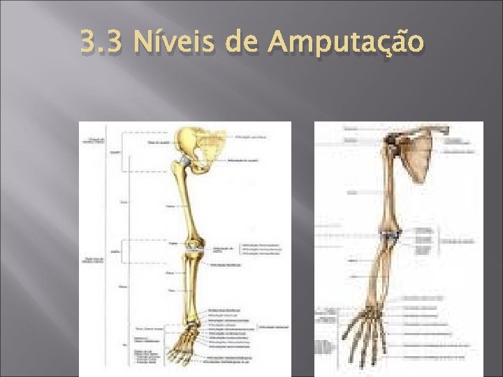 3. 3 Níveis de Amputação 