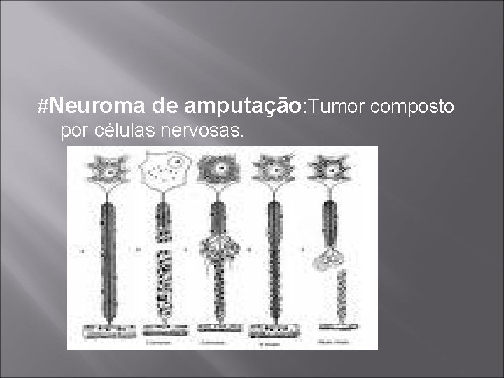 #Neuroma de amputação: Tumor composto por células nervosas. 