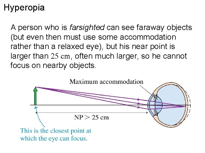 Hyperopia A person who is farsighted can see faraway objects (but even then must