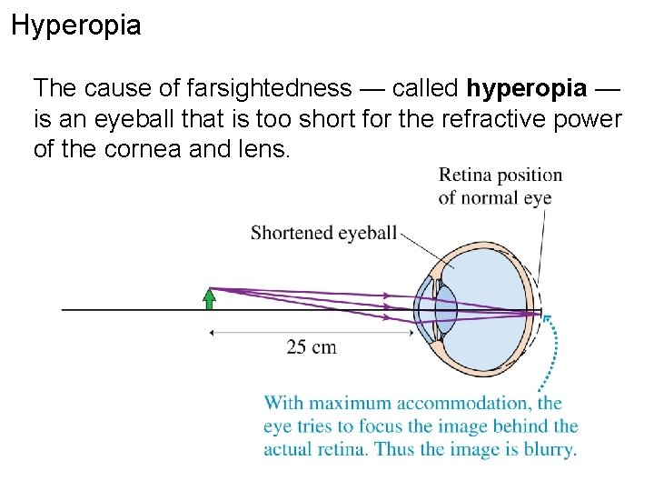 Hyperopia The cause of farsightedness — called hyperopia — is an eyeball that is