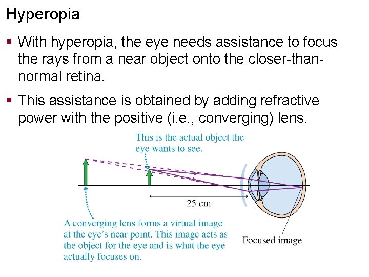 Hyperopia § With hyperopia, the eye needs assistance to focus the rays from a