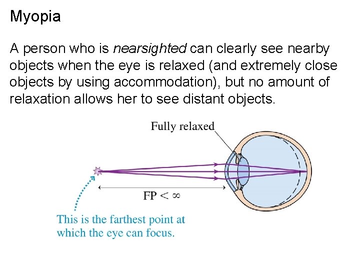 Myopia A person who is nearsighted can clearly see nearby objects when the eye
