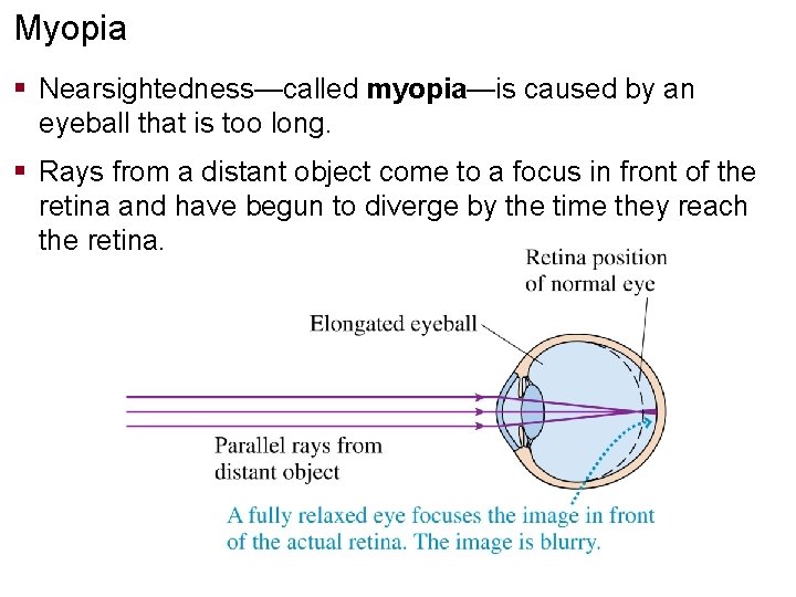 Myopia § Nearsightedness—called myopia—is caused by an eyeball that is too long. § Rays