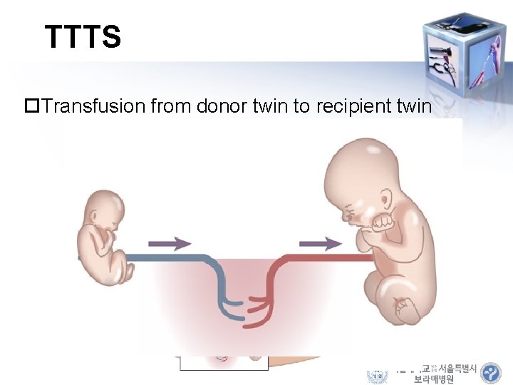 TTTS Transfusion from donor twin to recipient twin 