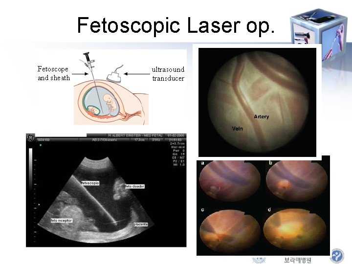Fetoscopic Laser op. 