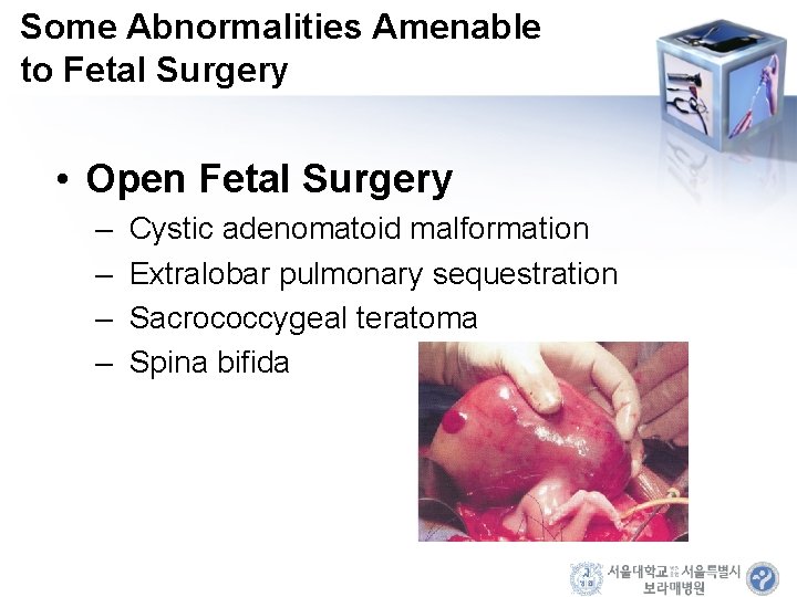 Some Abnormalities Amenable to Fetal Surgery • Open Fetal Surgery – – Cystic adenomatoid