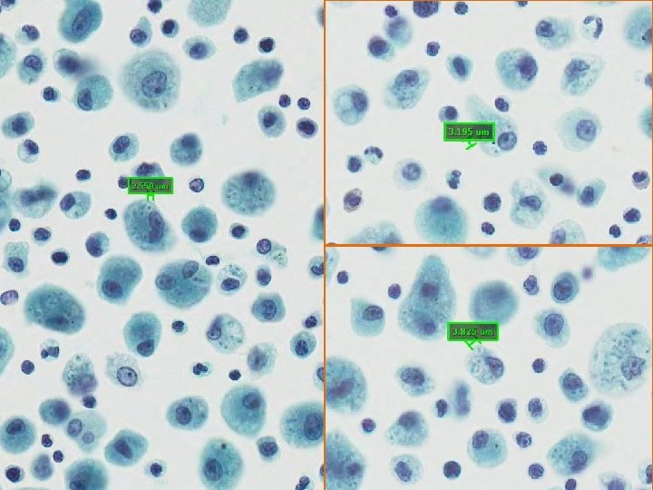Cytologic characteristics Cellularity high Cellular composition ...