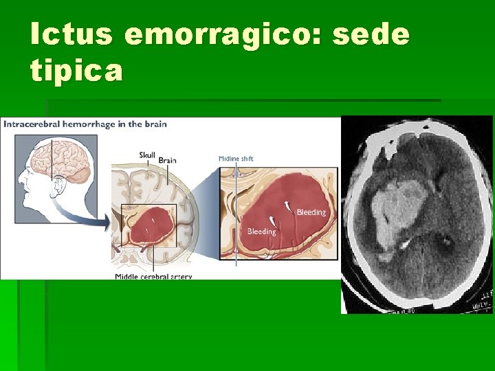 Ictus emorragico: sede tipica Ictus emorragico: sede tipica