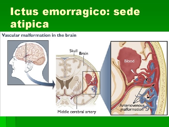 Ictus emorragico: sede atipica Ictus emorragico: sede atipica